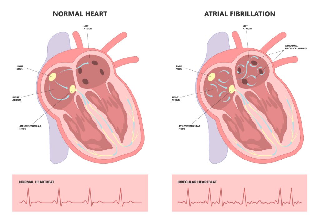 Concierge Care norvinia afib 02