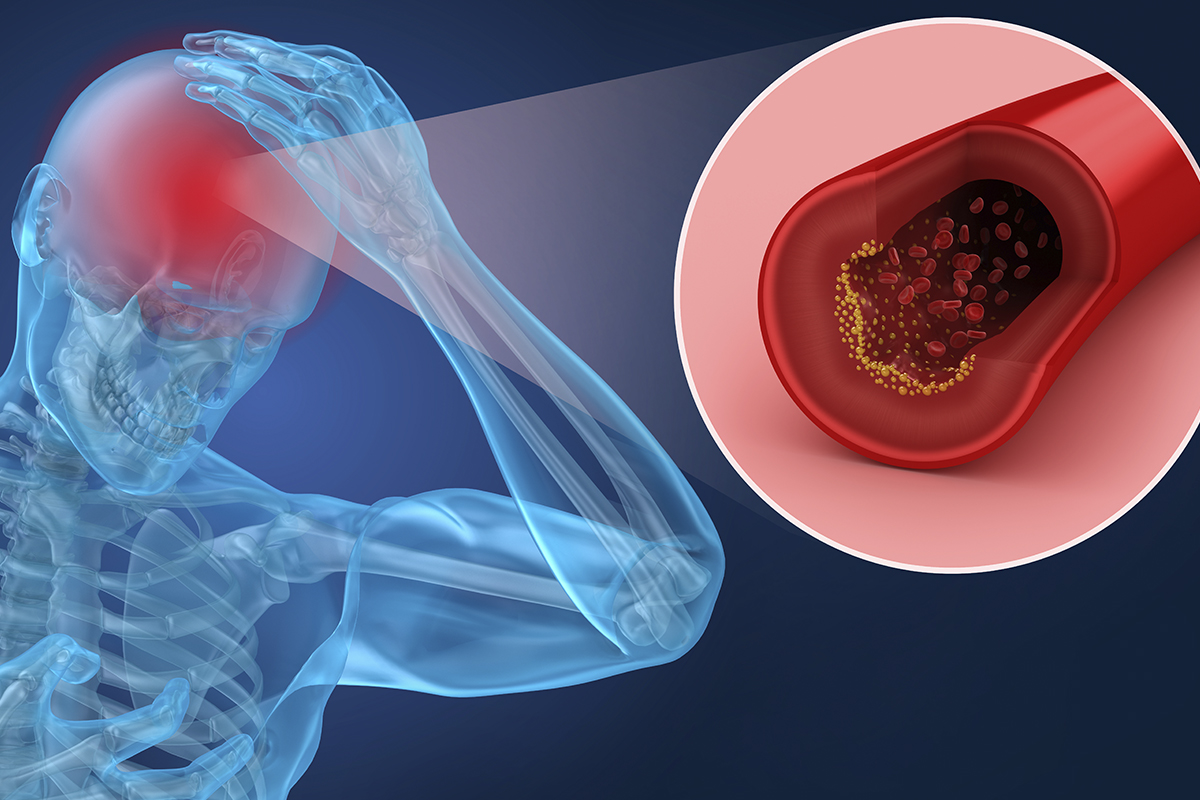 Primary Care Stroke: Prevention, Recognition, and Long-Term Care 2 Illustration of blood clot causing stroke risk