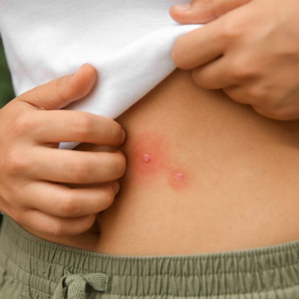 bug-bite-treatment