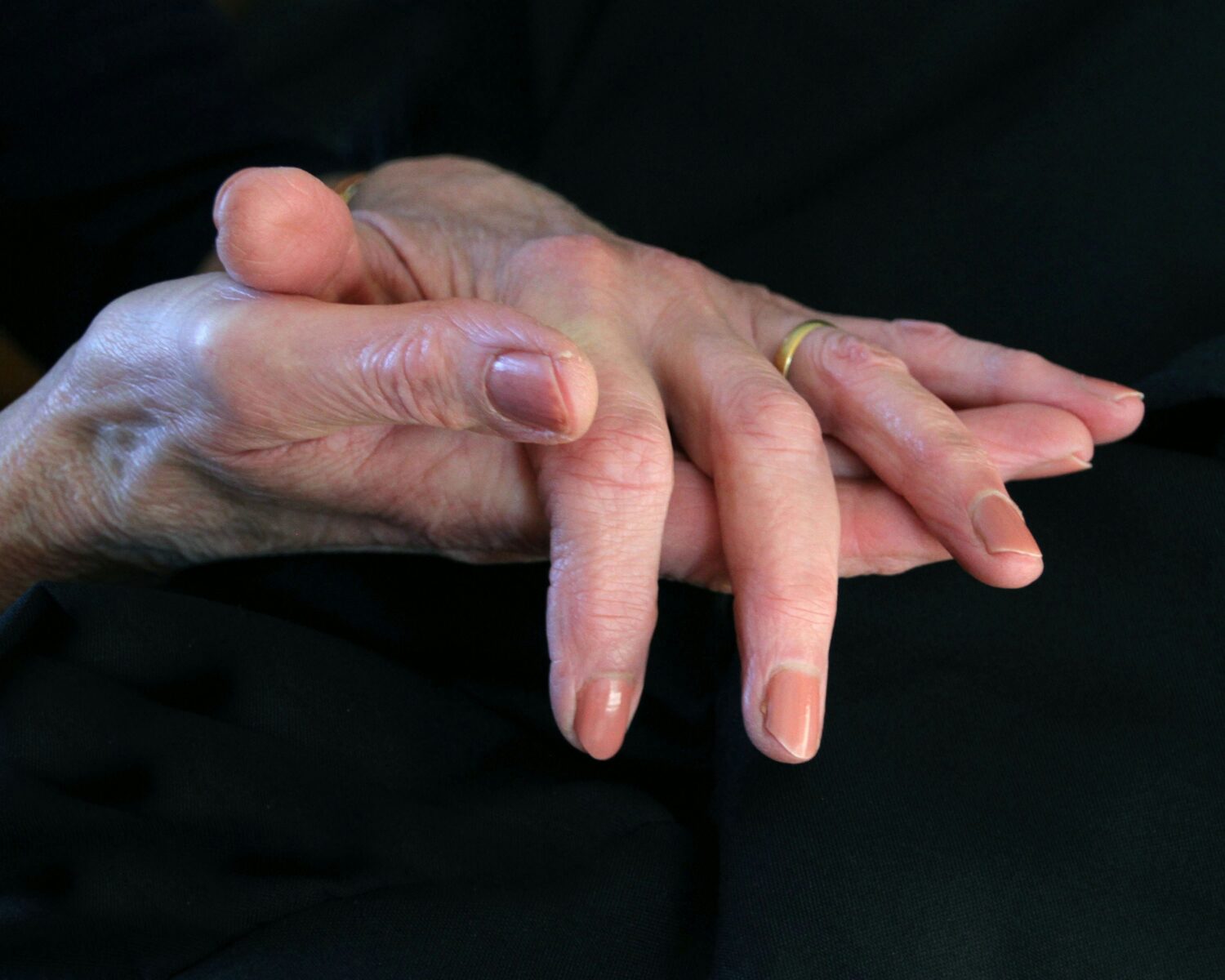 Primary Care Arthritis 1 Elderly hand showing joint changes managed with arthritis treatment Fairfax care